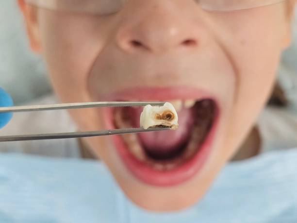Best Urgent Care for Lost Fillings or Crowns in Franklin, WI