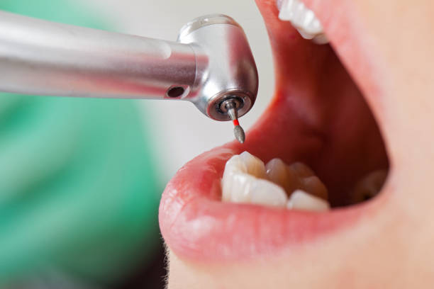 Best Emergency Wisdom Teeth Removal in Franklin, WI